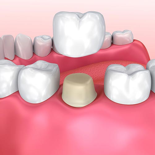 Cosmetic dentist in Brampton offers dental crowns