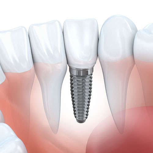 dental implants restorative dentistry in Brampton illustration